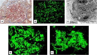 Eculizumab as a New Treatment for Severe Acute Post-infectious Glomerulonephritis: Two Case Reports